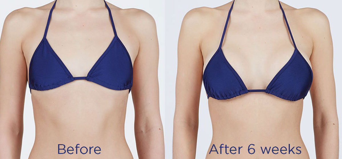 Breast procedure before and after