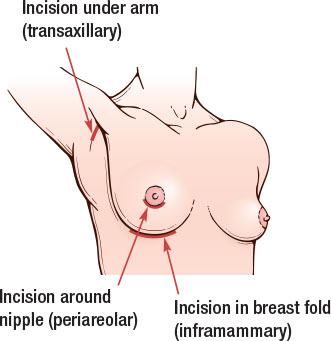 Breast incision illustration